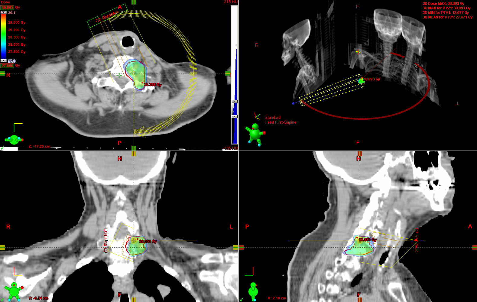 Men more susceptible to thyroid cancer metastasis